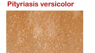 Pityriasis versicolor  superficial fungal infection [upl. by Anigue]