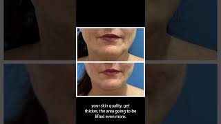 Before and After  PDO Thread Facelift thread threadlift nonsurgicalfacelift nonsurgical [upl. by Sofie]