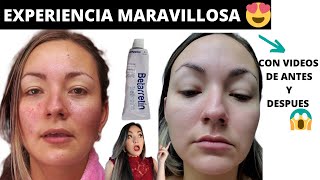 RETINOL ANTES Y DESPUES😱 TRETINOINA MI EXPERIENCIA DESPUES DE 6 MESES betarretin acido retinoico [upl. by Skardol]