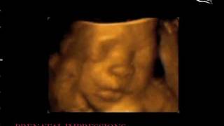 28 weeks 3D Ultrasound 4D Ultrasound [upl. by Yrogerg]