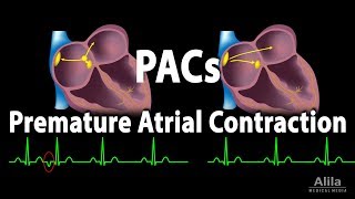 Premature Atrial Contractions PACs Animation [upl. by Neroc]