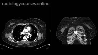 How to report incidental breast lesions on CT [upl. by Giusto]