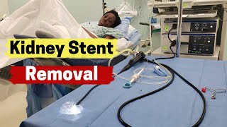 Kidney Stent Removal  What is Involved in Kidney Stent Removal [upl. by Eugirne]