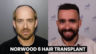 Norwood 6 Hair Transplant Journey  2 Session  7750 Graft  Beard Extraction  Unshaven Transplant [upl. by Cantone]