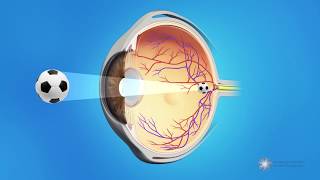 Posterior Capsule Opacification PCO  Also known as Secondary Cataracts or Cataract Scar Tissue [upl. by Linnie727]