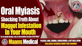 Oral Myiasis  Shocking Truth About Maggot Infestation In Your Mouth  Maams [upl. by Mauralia]