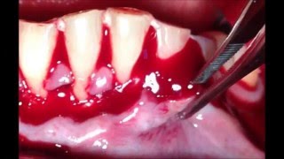 GINGIVAL RECESSIONCORONALLY REPOSICIONED FLAP WITH PLATELED RICH FIBRINE PRF Esp BRITTO FALCON [upl. by Nonez479]