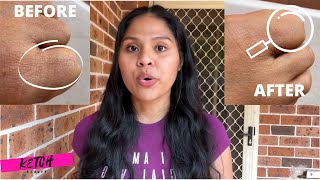 At Home Laser Hair Removal Before and After  Destiny Maylas [upl. by Theo]