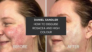 How To Disguise Rosacea and High Colour [upl. by Yttisahc]