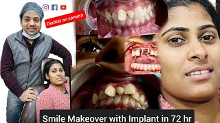 Smile Makeover in 3 days with Corticobasalimplant amp Zirconia crowns  Dr Mangal Gupta [upl. by Mary]