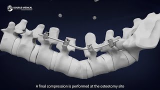 Pedicle Subtraction Osteotomy PSO Procedure with Double Medical PSO Instrument Set [upl. by Adrell]