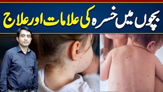 Measles Symptoms amp Treatment  Measles Treatment For Babies  Khasra Ki alamat Aur ilaj [upl. by Anoiek980]