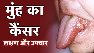 Mouth Cancer Hindi  1mg [upl. by Yajet934]