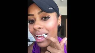 Adult Braces Vlog 6 Palate Expander Removal Dental Implants Snapchat Mariah Navit [upl. by Adas]