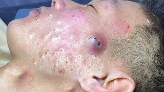 Big Cystic Acne Blackheads Extraction Blackheads amp Milia Whiteheads Removal Pimple Popping  409 [upl. by Gillead]