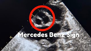 Mercedes Benz Sign in Fetal Echocardiography [upl. by Hannover]