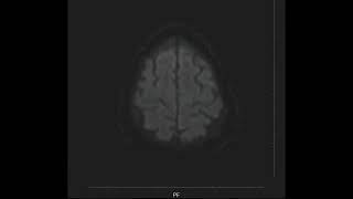 Left Medullary Infarct MRI [upl. by Ingraham]