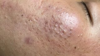 ACNE TREATMENT VU QUYNH MI  Blackheads On Boy Face 2024FULL [upl. by Egiarc627]