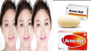 Acne  Aid Soap  Best medicated soap foroily and acne skin [upl. by Morita908]