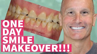 New Teeth in One Day Smile Makeover with Dental Veneers and Crowns [upl. by Mateya]