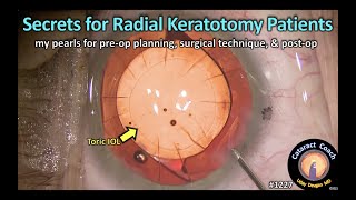 Cataract 1227 secrets for radial keratotomy patients having cataract surgery [upl. by Mrots81]