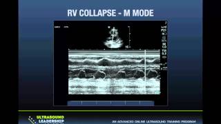 Ultrasound Podcast  PERICARDIAL TAMPONADE LEARN THIS KNOW THIS [upl. by Akeirahs]