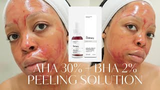 THE ORDINARY AHA 30  BHA 2 PEELING SOLUTION REVIEW [upl. by Winther]