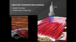 Webinar Ultrasound Guided Hip Injections [upl. by Annawyt]