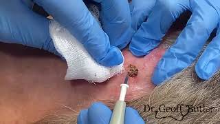 REMOVAL OF A SQUAMOUS CELL CANCER FROM BEHIND THE EAR [upl. by Yanel]