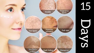 Melasma  Hyperpigmentation treatment  Dark spot  Chaiyan khatam krne ka tarika [upl. by Cherise]