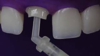 EN Fiberglass Posts and Core Buildups Cementation PROTOCOL [upl. by Navap]