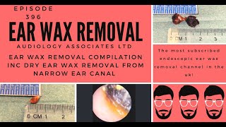 EAR WAX REMOVAL COMPILATION INC DRY EAR WAX REMOVAL FROM NARROW EAR CANAL  EP 396 [upl. by Picardi770]