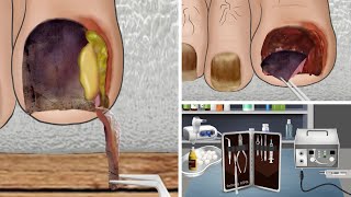 ASMR Ingrown Toenail removal treatment animation relax  리얼한 내성 발톱 케어 애니메이션 [upl. by Bej34]