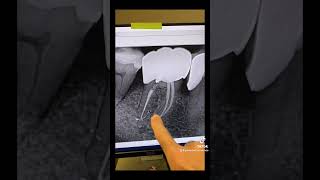 Still not convinced 1 appointment RCT on an abscessed tooth works Watch this video [upl. by Eetsirhc128]