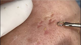 Blackheads Removal  LyLyBeautySpa [upl. by Devinna]