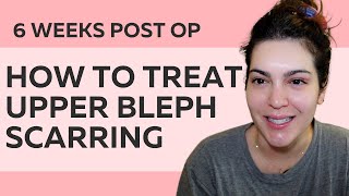 6 WEEKS POST OP UPPER BLEPHAROPLASTY SCARS amp HOW TO TREAT THEM before amp after photos too [upl. by Aihsenak]