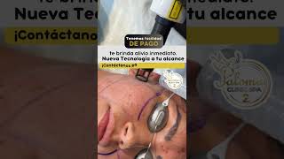 Láser para Cicatriz de Acné acne laseracne acnescars [upl. by Sheba926]