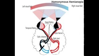 homonemous hemianopia [upl. by Chappell]