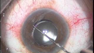 Reposition of subluxated IOL [upl. by Xuerd867]