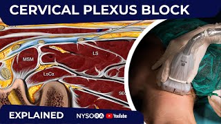 Cervical Plexus Block  Regional anesthesia Crash course with Dr Hadzic [upl. by Isia]