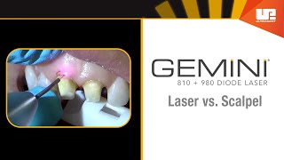 Gemini Clinical – Gingivectomy [upl. by Kenny]