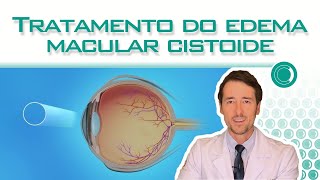 Tratamento do Edema Macular Cistóide [upl. by Katrina495]