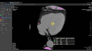 Vitrea Demonstrations  Cardiac Calcium Score [upl. by Darcey]