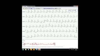 Analysis For HOLTER 48 Hours Software In English By Eng Mohamed El Ashry [upl. by Suirred]