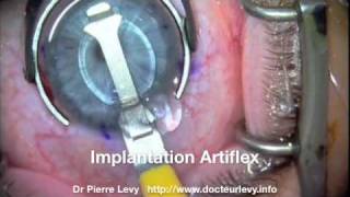 Opération myopie forte par implant Phake Dr Pierre Levy Montpellier France Implantation Artiflex [upl. by Sochor]