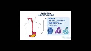 Achalasia A Disorder of the Esophagus health [upl. by Nalak]