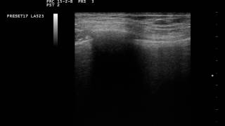 Lung Pulse in ecografia toracica [upl. by Demmahom41]