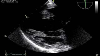 3 RUPTURE CHORDAE TRANSGASTRIC TOE VIEW MITRAL REGURGITATION [upl. by Astred]