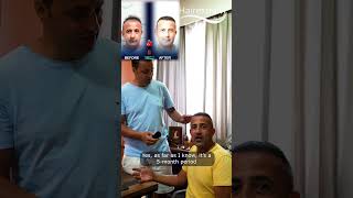 Mryılmaz achieved amazing hair transplant results after 5 months hairtransplantresults [upl. by Adahs]