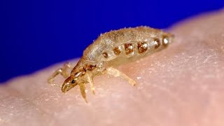 Body Lice Treatment  Symptoms and Causes  Diagnosis  Prevention [upl. by Chaille606]